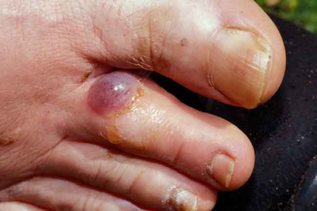 What are Blisters?